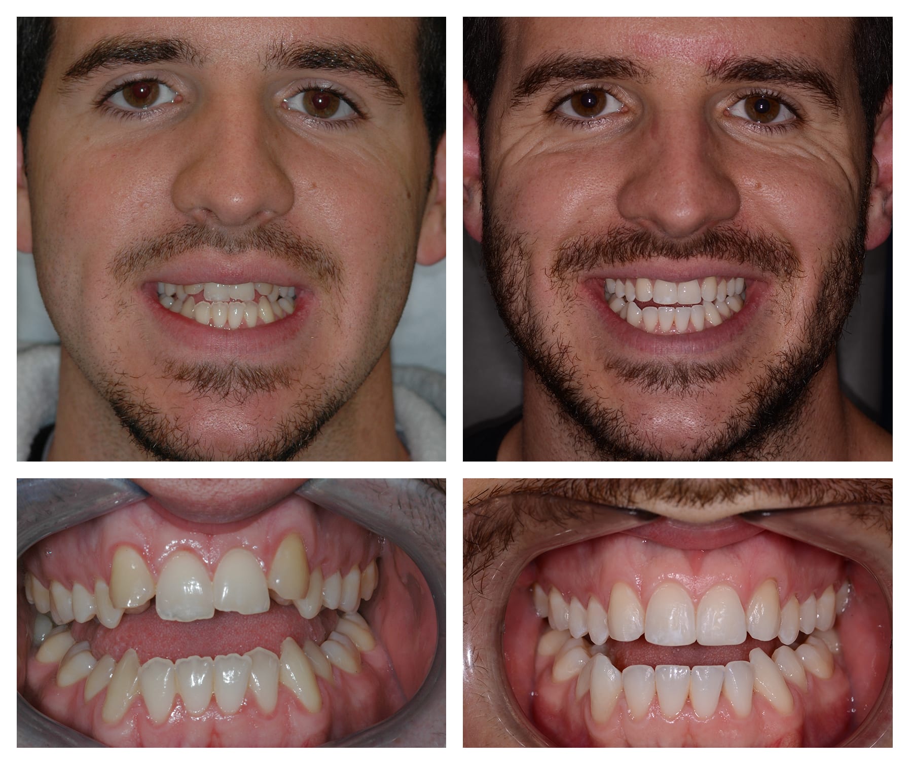 Orthodontist Surrey - Invisalign Invisible Braces Surrey